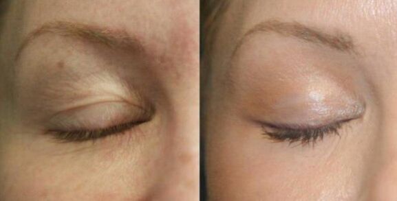 Care for areas near the eyes