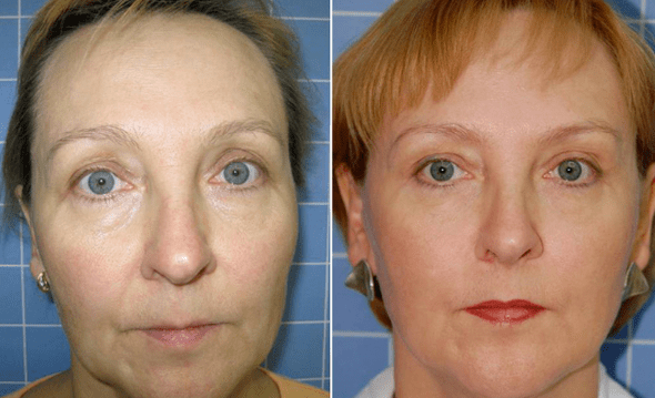 Before and after the renewal process