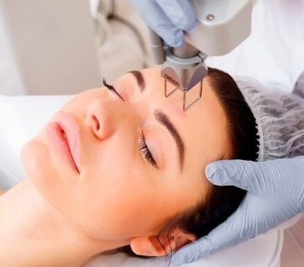 the essence of the fractional laser facial skin renewal procedure