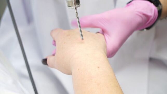 Laser hand skin renewal