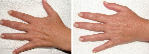 Result of removal of pigment spots on the hands