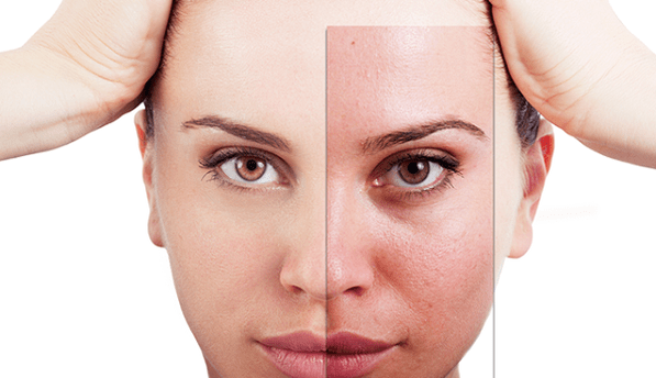 Fractional rejuvenation removes the main aesthetic defects in the face