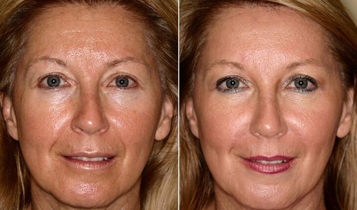 before and after rejuvenating facial skin at home